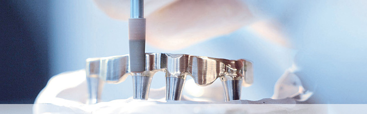 Implantate, Implantologie Bremen